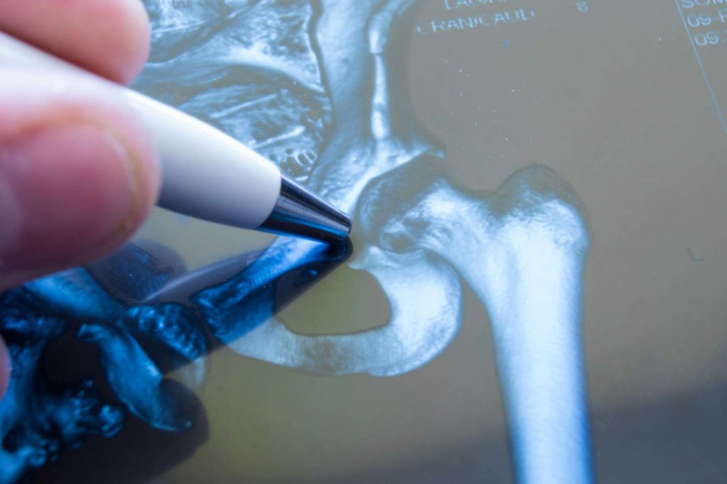 X-Ray Of Broken Hip
