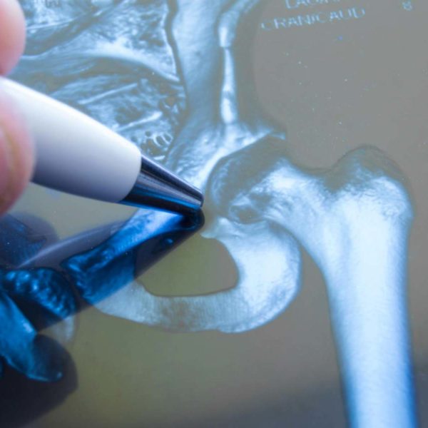 X-Ray Of Broken Hip