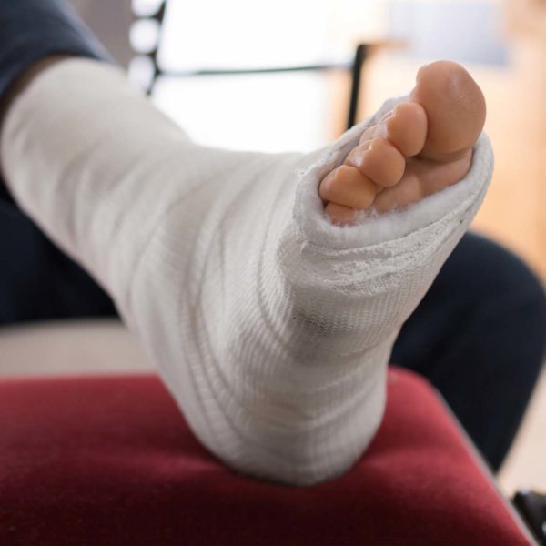 Image Of Broken Foot In Cast